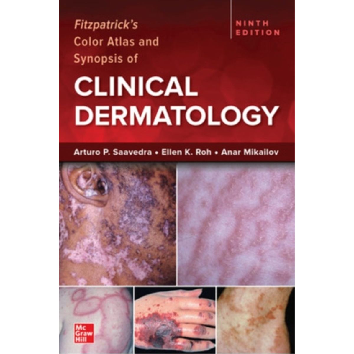 Fitzpatrick's Color Atlas and Synopsis of Clinical Dermatology, Ninth Edition